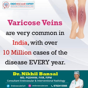 Consult with varicose veins doctor in Jaipur